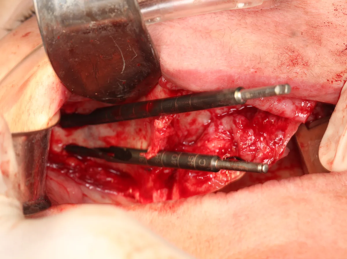 Foto cirúrgica: instrumentos nas duas osteotomias zigomáticas do mesmo lado, com marcação de profundidade