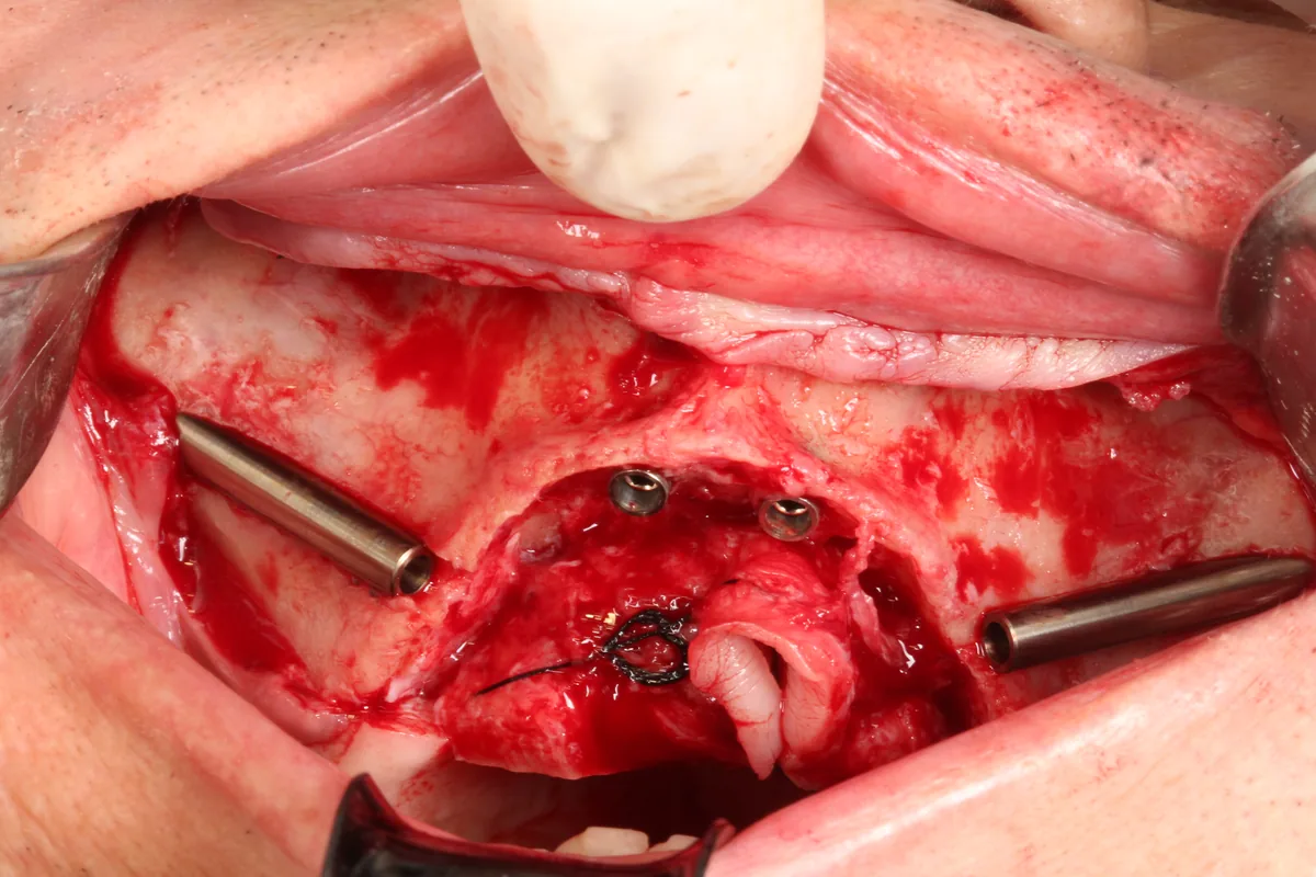 Foto cirúrgica: um implante zigomático de cada lado e dois implantes anteriores