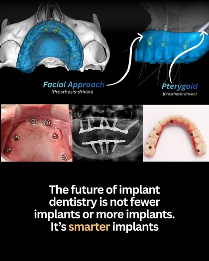 Post de 30 mar 2026: Mais implantes ou menos implantes? Essa é a pergunta errada.