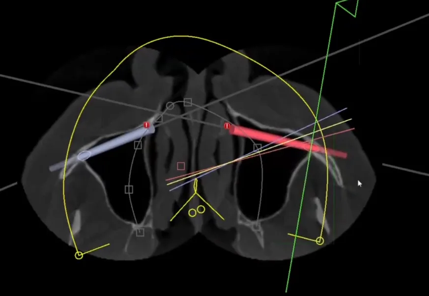 Corte axial da tomografia com as duas trajetórias zigomáticas planejadas, uma de cada lado