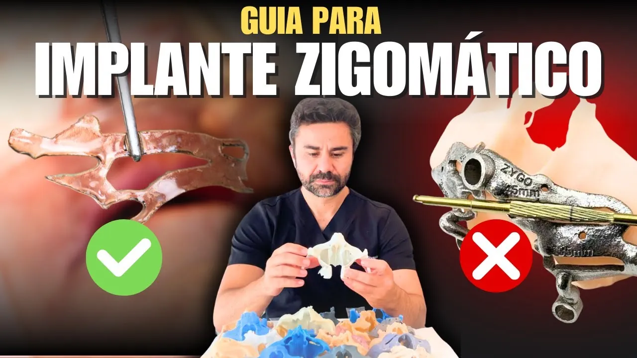 Capa da vídeo-aula Implante Zigomático com Guia