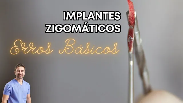Capa do vídeo: Implantes zigomáticos: erros básicos